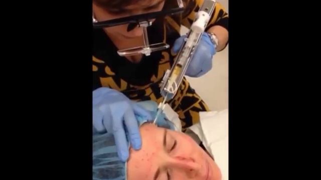 Mesotherapy or Mesolift at the Clinique Anti Aging of Montreal