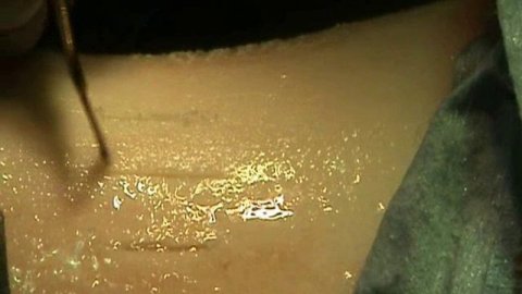 Работа пьезо-хирургической насадки OT7