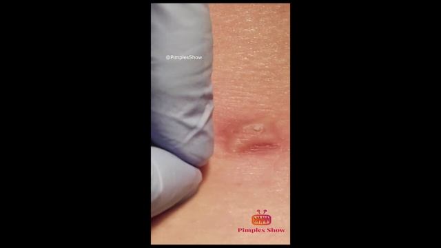 выдавливание прыщей | выдавливание чёрных точек