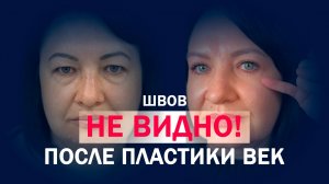 Круговая блефаропластика: когда взгляд становится моложе