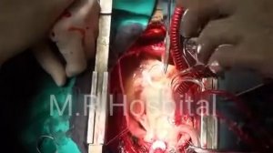 open-heart surgery Surgery Heart surgery M.R Hospital.