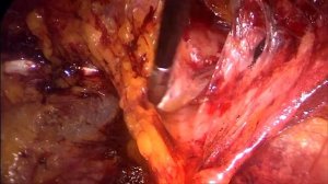 Фиксация полипропиленовой сетки медицинским клеем