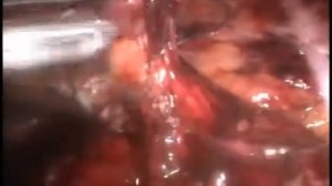 Фиксация протеза клеевой композицией при eTEP