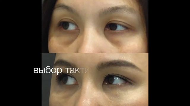 Вебинар "Коррекция возрастных изменений параорбитальной области"