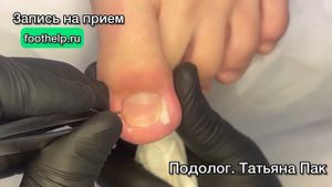 «Рогатка» в мясе бокового валика у ребенка 11 лет