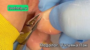 Многослойное образование КОЖИ в местах давления и трения. Мозоль