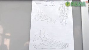 Хирургия стопы: ДО и ПОСЛЕ. Лечение вальгусной деформации. Hallux valgus.