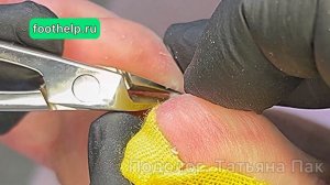 Фиброзная ткань под сухой мозолью, которая болит, колет, печет и пульсирует #подологтатьянапак