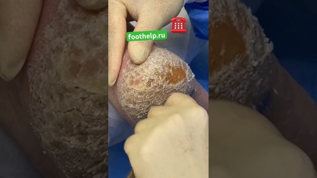 Ваша проблема- моя помощь #подологтатьянапак #гиперкератоз