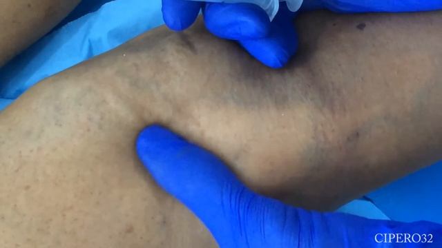 Sclerotherapy  varicose veins   Legs