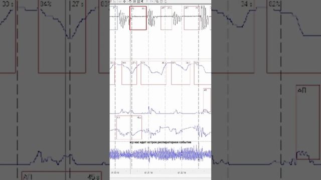 Обструктивное апноэ сна на мониторе смотреть онлайн