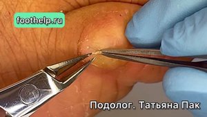 Удаляю МОЗОЛЬ полностью, но растет снова