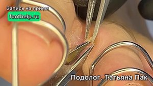 Корешковая мозоль справа и слева на пальцах в месте соприкосновения, трения и давления