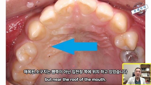 입천정 안에 매복된 치아 수술발치 과정 #치아교정 #임플란트 Surgical extraction of the impacted premolar in the palate