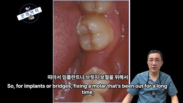 빠진 치아 방치하여 교합이 무너진채로 임플란트나 브릿지 보철 해넣어도 되나요