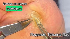 Место образования сухих мозолей. Как облегчить болезненное состояние