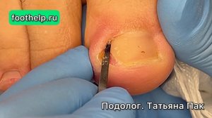 Форма вросшего ногтя | найти точку боли