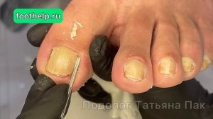 Кожные залежи в боковых пазухах ногтя | ноготь в трубочку #подологтатьянапак