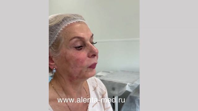 Отзыв нитевой лифтинг лица Аптос смотреть онлайн
