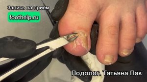 Доврачебная подготовка пораженного ногтя к лечению. Чистка онихомикоза