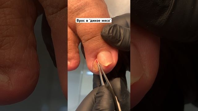 Вросший ноготь прорезал грануляцию бокового валика #вросшийноготь