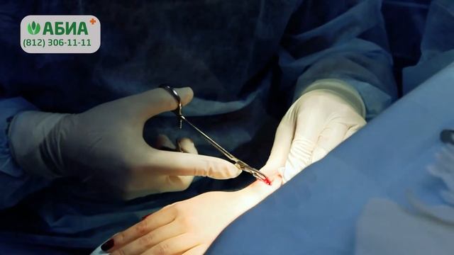 Удаление гигромы кисти в клинике "АБИА" смотреть онлайн