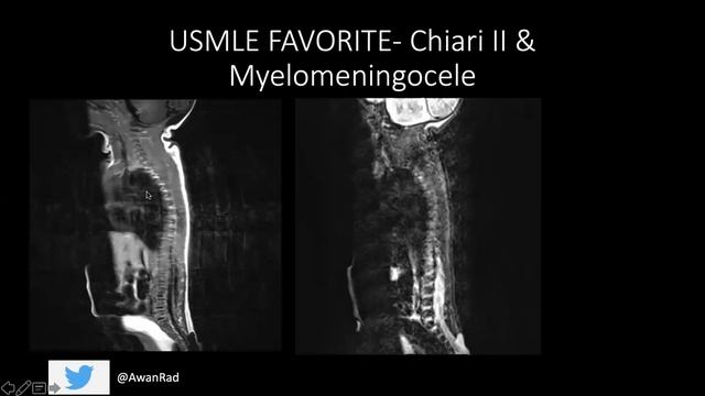 USMLE DOMINATION: HIGH YIELD TUTORIAL #5- Posterior Fossa Malformations