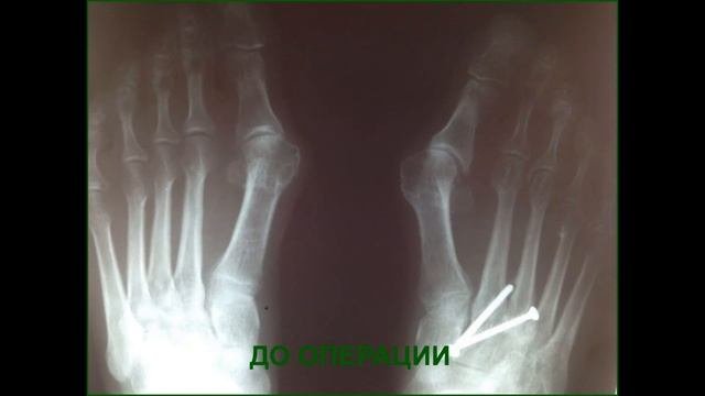 Хирургия стопы. Лечение вальгусной деформации. Hallux Valgus.