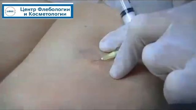 склеротерапия | флеболог Красильников | Самара Центр Флебологии ЦФИК