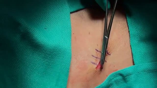 Mohs Closure with Quill Monoderm смотреть онлайн