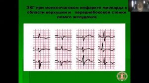 Острый инфаркт миокарда Часть 2