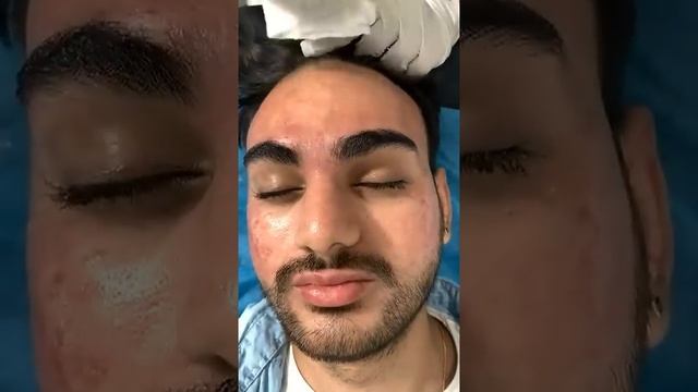 carbon laser treatment for skin whitening | carbon laser 🥰😍 | Skinaa Clinic viral #shorts смотреть онлайн