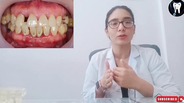 dental calculus//dental plaque//Tartar//tartar क्या होता है और इससे कैसे बचें смотреть онлайн