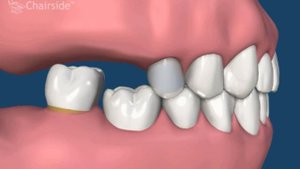 Что происходит при отсутствии зубов на нижней челюсти