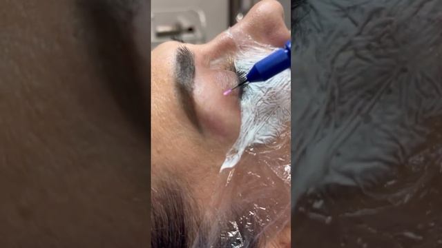 Холодная плазма - помощник косметолога холоднаяплазма косметология