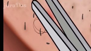 Asmr Remove Head Lice & Information Remove#asmr