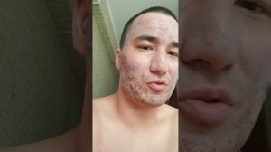 лазерная шлифовка 3 день