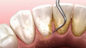 Гигиена полости рта ультразвуковая машина для чистки зубов, удаляющая зубной камень и зубной налет