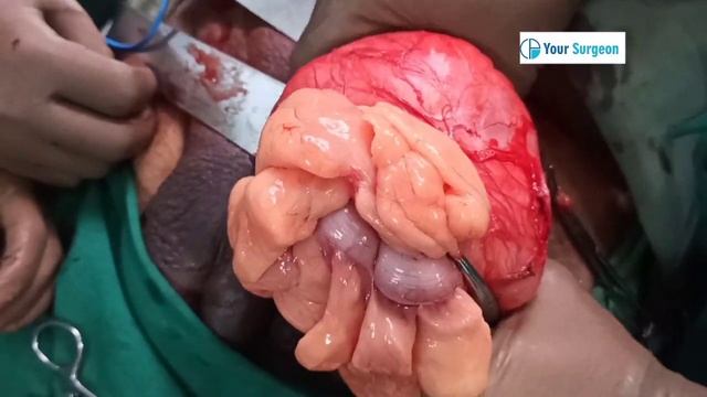 IF HERNIA NOT TREATED - WHAT CAN HAPPEN ? смотреть онлайн