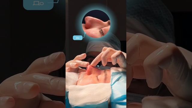 Результат вторичной мужской  риносептопластики на операционном столе 💡