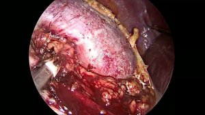 Резекция правой почки