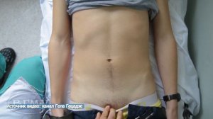 Пальпация поверхностного пахового кольца