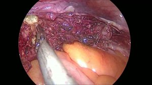 гистерадреналэктомия