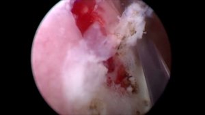 Лейкоплакия мочевого пузыря