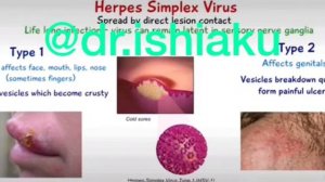 HERPES SIMPLEX VIRUS 🦠 TYPE1 & 2 full explanation by #drishiaku