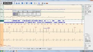 5. Нарушения ST