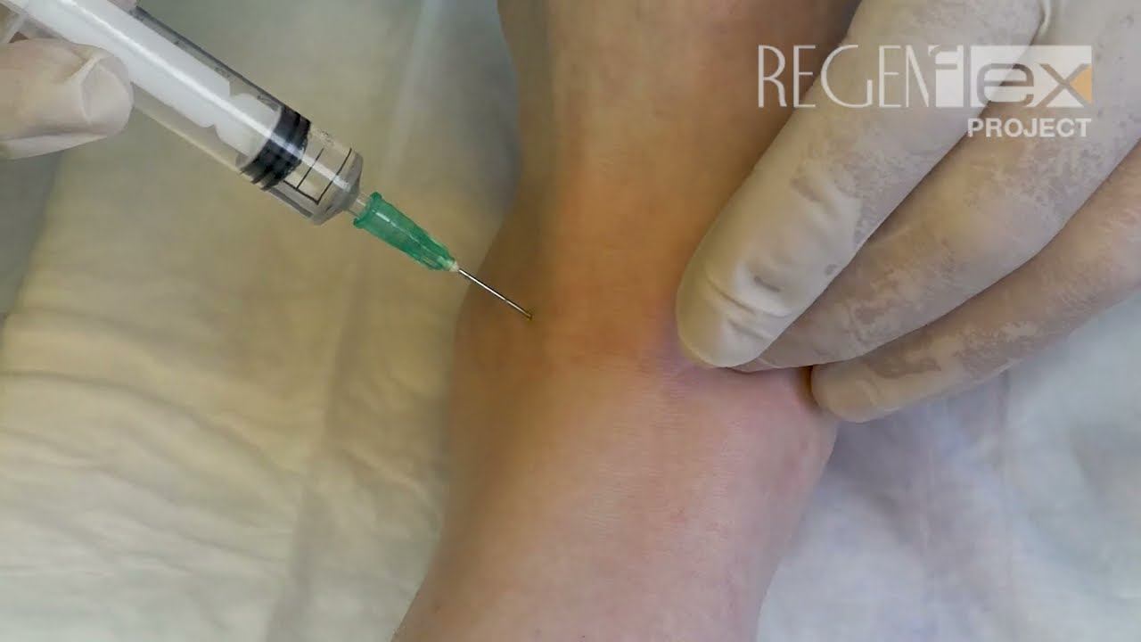Инъекция REGENFLEX Starter в голеностопный сустав смотреть онлайн