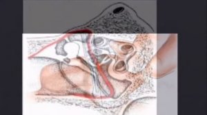 Тимпанопластика