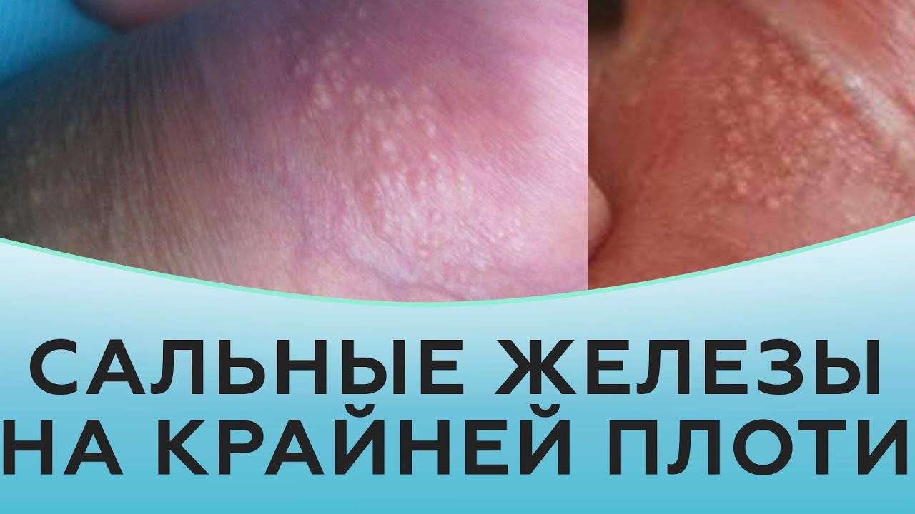 Сальные железы на крайней плоти