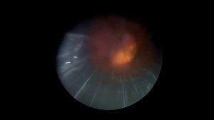 перкутанная нефролитотрипсия